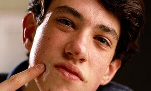 Teen Acne Treatment Teen Acne Treatment