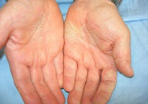 How to Treat Dermatitis in Six Simple Ways How to Treat Dermatitis in Six Simple Ways