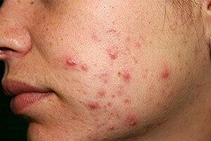 Best Acne Treatments Depend On The Case Best Acne Treatments Depend On The Case
